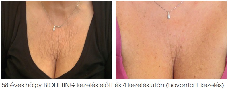 Guna BIOLIFTING dekoltázs fiatalítás